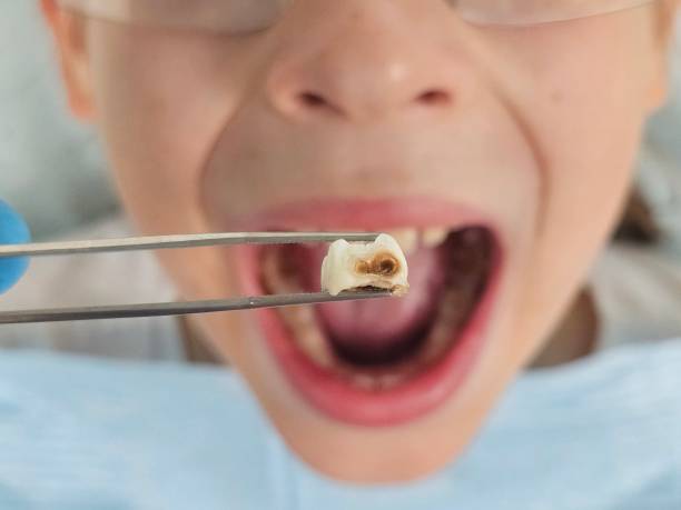 Best Emergency Dental Care for Broken or Chipped Teeth in Rolla, ND